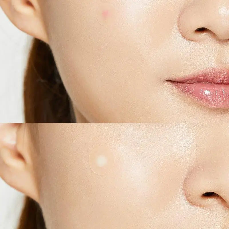 Cosrx: Pimple Master